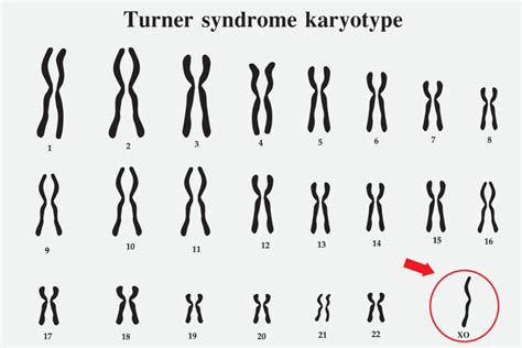 quantos cromossomos há no cariótipo de uma pessoa com síndrome de turner